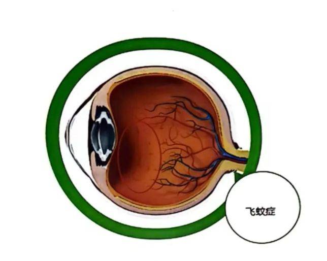 飛蚊癥治療最新突破，開啟視界新篇章